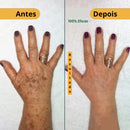 577 YUXINTANG - Spray que Remove manchas de SOL, IDADE E MELASMA! 50% DE DESCONTO + FRETE GRÁTIS!