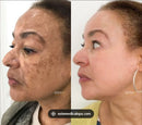 577 YUXINTANG - Spray que Remove manchas de SOL, IDADE E MELASMA! 50% DE DESCONTO + FRETE GRÁTIS!